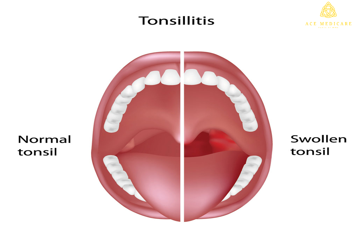 Tonsillitis and Pregnancy: Safety Precautions and Treatment Options